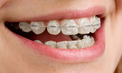 How Do Rubber Bands Work For Orthodontic Braces? - Hillsdale Orthodontics